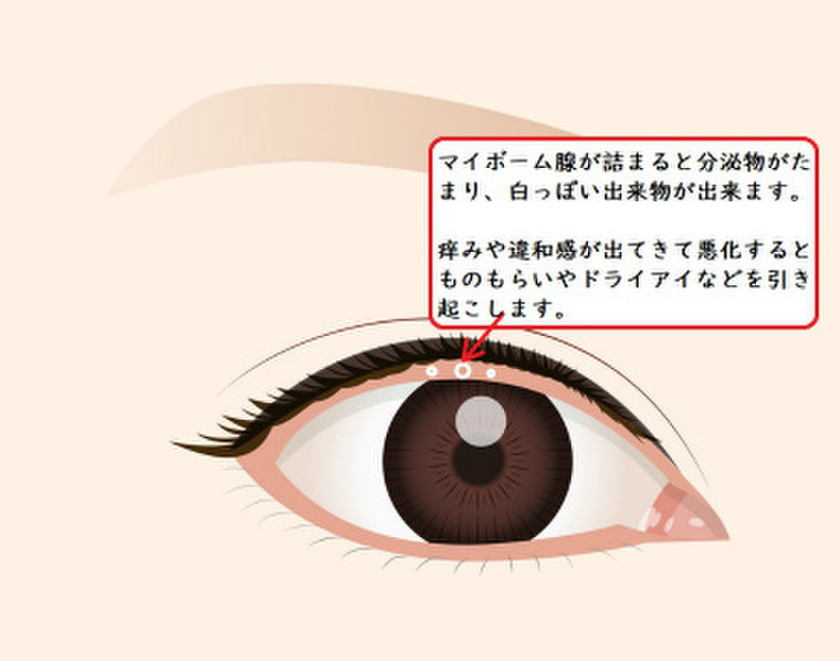 ものもらい メイク ものもらいの治し方：早く治すにはどうする？