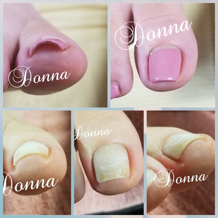 巻き爪ケア3回目m澤kさま 右足 芝原 潤さんのブログ Cosme アット 巻き爪ケア3回目m澤kさま 右足 芝原 潤さんのブログ Cosme アット