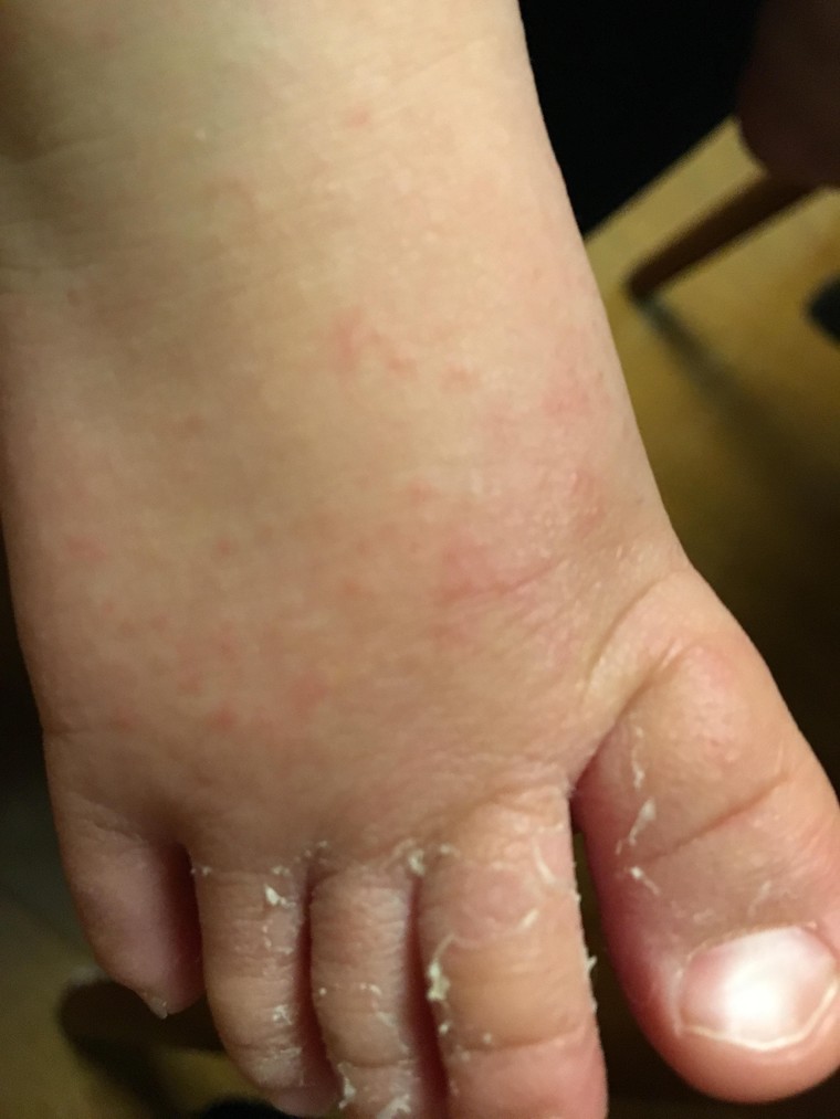 赤ちゃんの肌トラブル 乾燥 汗 アレルギー 大窪 由佳さんのブログ Cosme アットコスメ 赤ちゃんの肌トラブル 乾燥 汗 アレルギー 大窪 由佳さんのブログ Cosme アットコスメ