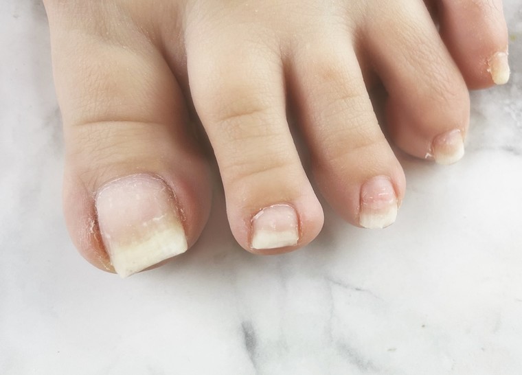 気になる 足の匂いの原因と正しい爪の切り方 Wakaさんのブログ Cosme アットコスメ