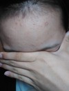 こっちにコメントお願いします…中学生 脂性肌 ニキビ のためのスキンケア