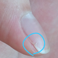 爪にヒビが 手の親指の爪にヒビが入りました ピンク色の Q A Cosme アットコスメ 爪にヒビが 手の親指の爪にヒビが入りました ピンク色の Q A Cosme アットコスメ