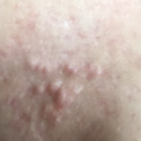 閲覧注意 教えてください フェイスラインのニキビ 何が Q A Cosme アットコスメ 閲覧注意 教えてください フェイスラインのニキビ 何が Q A Cosme アットコスメ