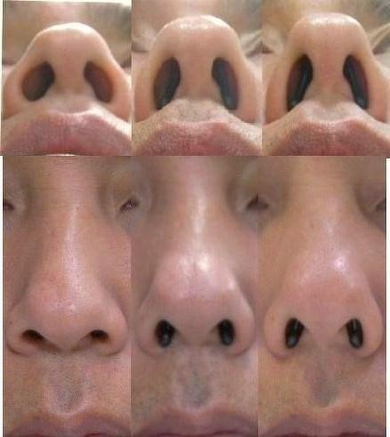 鼻プチの効果 ビフォーアフター画像あり エムエム さんのブログ Cosme アットコスメ