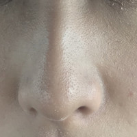 肌質 なにが原因 鼻周り 目の下あたりが写真のようにブ Q A Cosme アットコスメ 肌質 なにが原因 鼻周り 目の下あたりが写真のようにブ Q A Cosme アットコスメ
