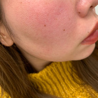 顔の赤みがひどい 生まれつき顔が赤く 常にボワッと火照っ Q A Cosme アットコスメ 顔の赤みがひどい 生まれつき顔が赤く 常にボワッと火照っ Q A Cosme アットコスメ