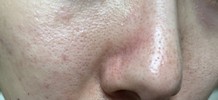 毛穴の種類について