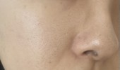 毛穴開きに長年悩んでます