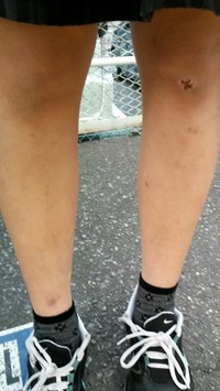 足の傷跡について 写真 嫌な方ごめんなさい 膝の傷 Q A Cosme アットコスメ