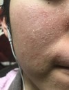 慢性化した肌荒れに悩んでいます。