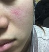 顔の部分的な赤みと痒み