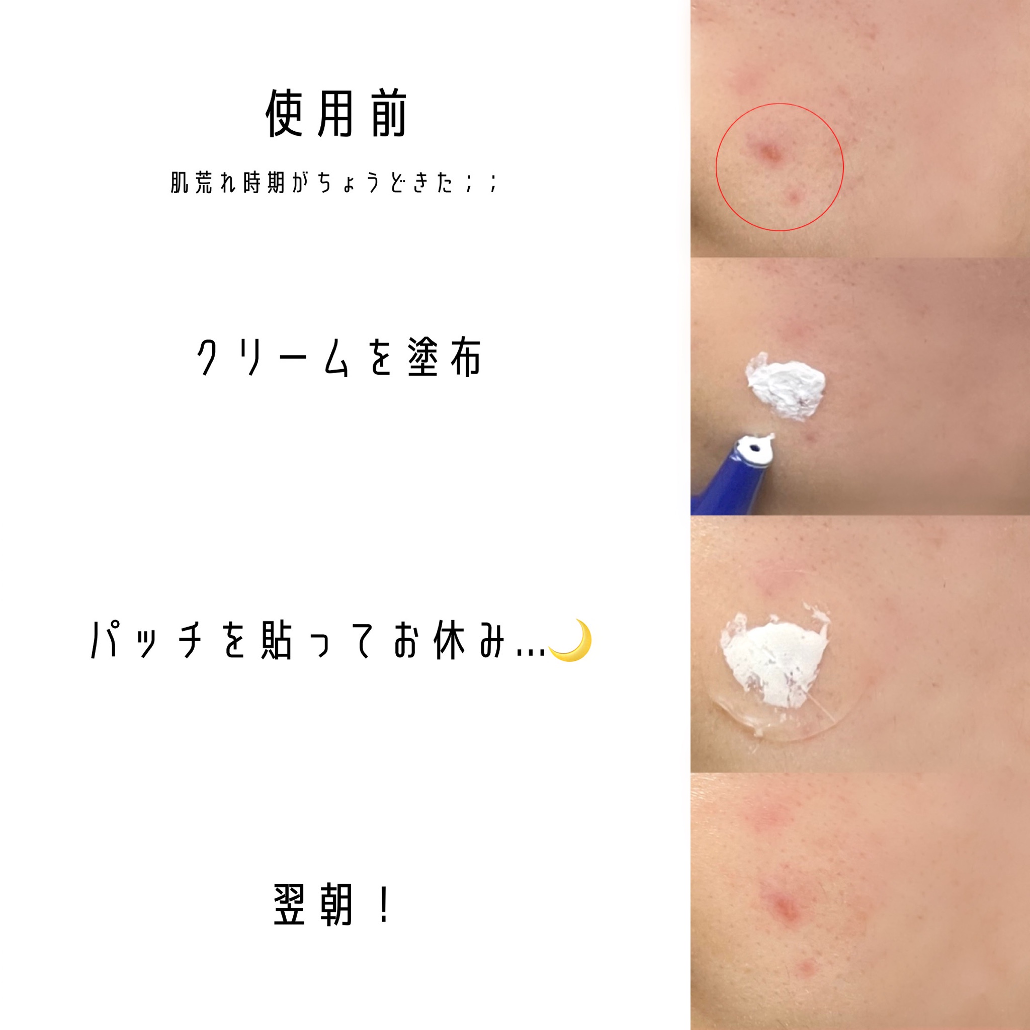 アクネスラボ ♡ 薬用ニキビケア 洗顔 化粧水 クリーム スポッツ