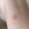 蚊に刺され？
