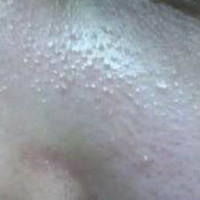顔の鮫肌 画像は拾い画ですが 私の鼻周りなどに小さいプツ Q A Cosme アットコスメ 顔の鮫肌 画像は拾い画ですが 私の鼻周りなどに小さいプツ Q A Cosme アットコスメ