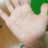 手荒れ？