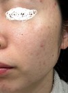 (※汚い肌の写真有)肌の状態、改善教えてください