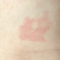 低温火傷をしました 写真のあたりが赤くなっていたの Q A Cosme アットコスメ 低温火傷をしました 写真のあたりが赤くなっていたの Q A Cosme アットコスメ