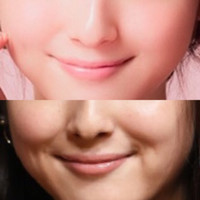 笑うとほっぺが盛り上がる顔だったのに 友達が激変 こん Q A Cosme アットコスメ 笑うとほっぺが盛り上がる顔だったのに 友達が激変 こん Q A Cosme アットコスメ