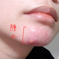 再掲 顎ニキビが5年間治りません 先ほど同様の質問をし Q A Cosme アットコスメ 再掲 顎ニキビが5年間治りません 先ほど同様の質問をし Q A Cosme アットコスメ