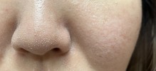 これは角質ですか？