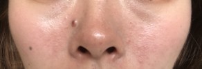 ずっとずっと悩んでいるいちご鼻と赤みについて（写真付き）