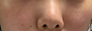 赤く、毛穴の開いた肌を治したいです
