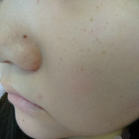 中学2年生です 汚い肌の写真があります 閲覧注意で Q A Cosme アットコスメ 中学2年生です 汚い肌の写真があります 閲覧注意で Q A Cosme アットコスメ