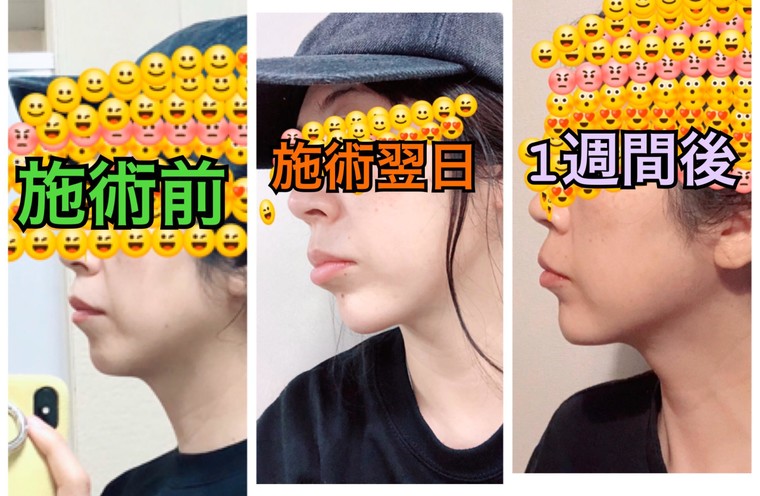 韓国美容の報告 今回は フィラーとダブロをやってきたよー そして お土産物 ヒヨコちゃん さんのブログ Cosme アットコスメ 韓国美容の報告 今回は フィラーとダブロをやってきたよー そして お土産物 ヒヨコちゃん さんのブログ Cosme アットコスメ