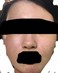 ニキビ 無くならない