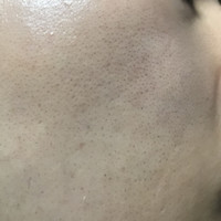 頬の毛穴 頬の毛穴が中々なくなりません 化粧水 ハトムギ Q A Cosme アットコスメ 頬の毛穴 頬の毛穴が中々なくなりません 化粧水 ハトムギ Q A Cosme アットコスメ
