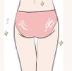 お尻の肉割れ (20代妊娠経歴なし･痩せ型)
