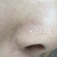 鼻の毛穴汚れについて 私は中学2年生です 中一の時から毛 Q A Cosme アットコスメ 鼻の毛穴汚れについて 私は中学2年生です 中一の時から毛 Q A Cosme アットコスメ