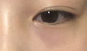 目のクマ