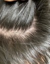 頭皮全体の赤み、フケ