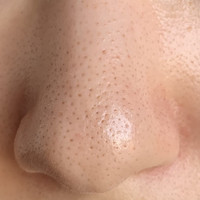 毛穴詰まりで悩んでいます 鼻の毛穴詰まりで悩んでい Q A Cosme アットコスメ 毛穴詰まりで悩んでいます 鼻の毛穴詰まりで悩んでい Q A Cosme アットコスメ