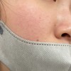 毛穴悩み