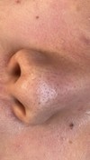 鼻の黒ずみ、ドナーパット