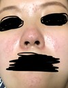 脂漏性皮膚炎でしょうか？