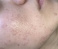 顔周りのニキビ 頬の毛穴