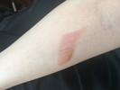 火傷の治し方