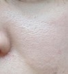 頬の開き(？)毛穴をなくなった方いますか？