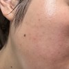 ※閲覧注意です レチノールA反応ですか？