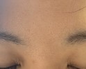 眉間、おでこの毛穴