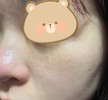 これってシミですか？肝斑？