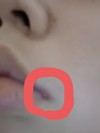 唇の上と下の間に出来物