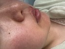 開き毛穴、鼻の黒ずみ