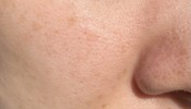 開き毛穴？メラニン毛穴？毛穴が気になります。