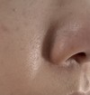小鼻、鼻下の赤み