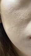 【注意】ほおの毛穴？たるみ？クレーター？