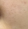 頬の毛穴と黒ずみ毛穴についてです